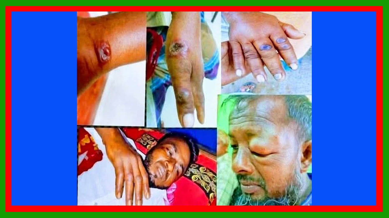 এবারে পীরগঞ্জে অ্যানথ্রাক্স রোগী শনাক্ত : গবাদী পশু জবাইয়ে বিশেষ নজরদারী