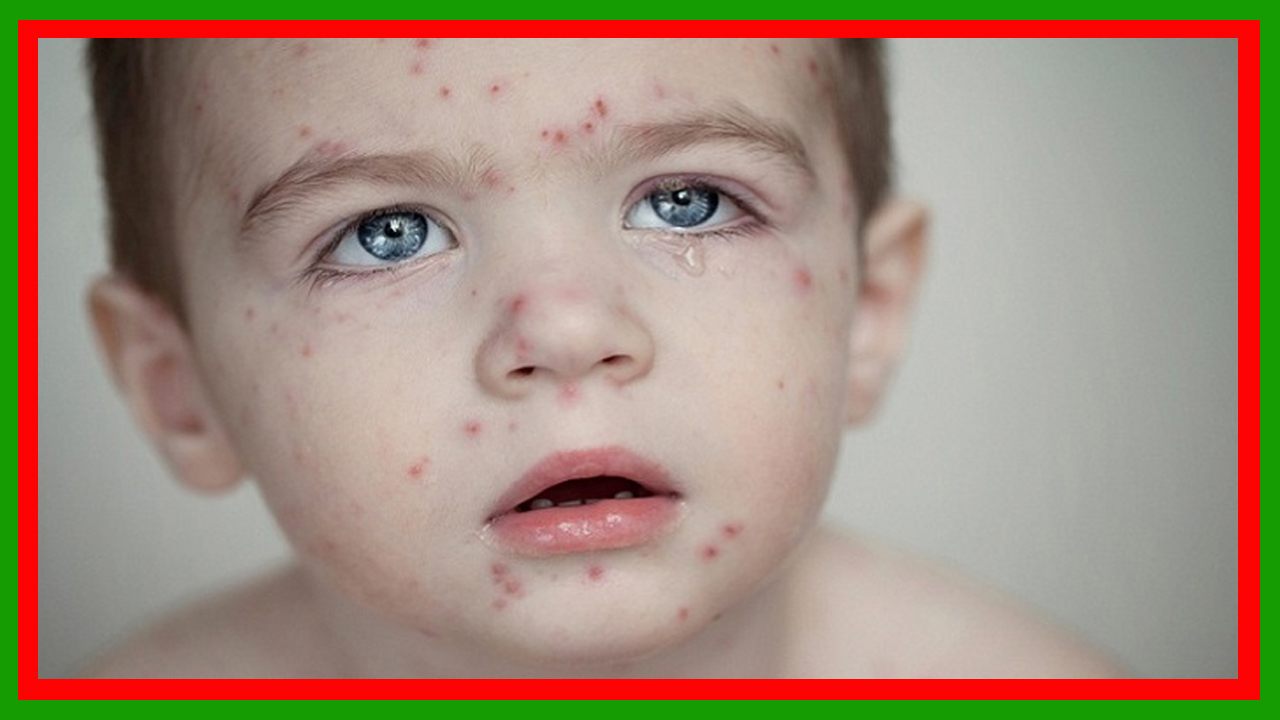 গত ২৪ ঘণ্টায় হামের উপসর্গে আরও ৩ জনের মৃত্যু : নতুন করে আক্রান্ত হয়েছেন ৯৪৭ জন